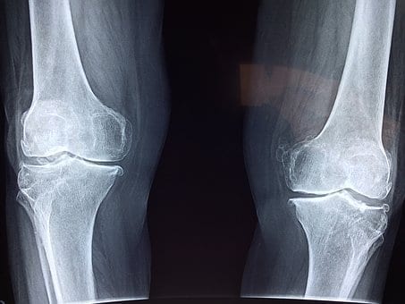 Traumatic Knee Injuries