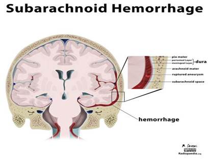 subarachnoid hemorrhage