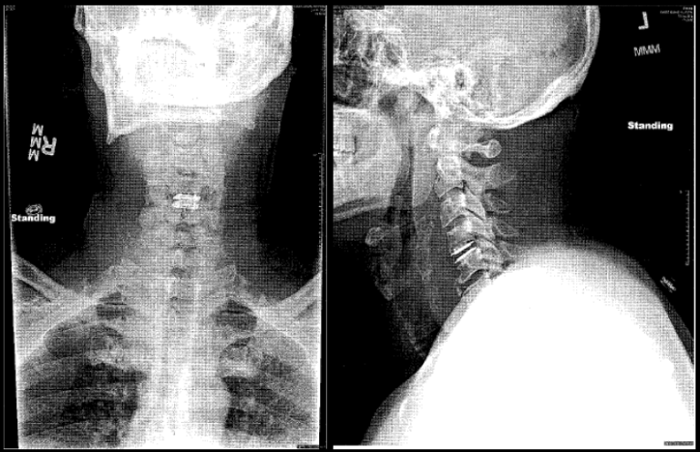 chavez xray