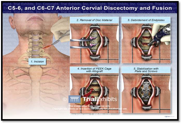 anterior cervical discectomy and fusion