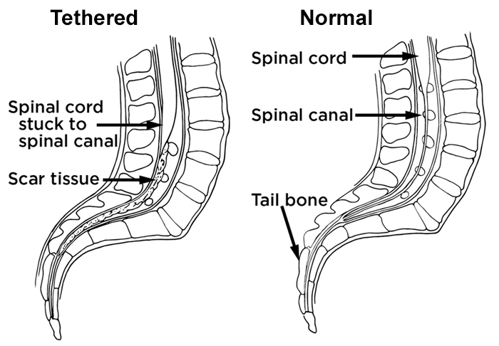 tethered vs normal spine