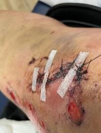 Our client’s injuries from motorcycle accident