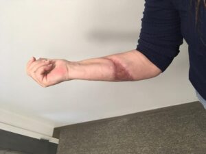 Actual client’s scarring caused by severe dog bite.