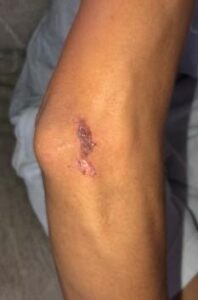 close-up of skin abrasion on the elbow of a teenager's arm