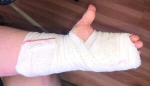 close-up of person's injured left hand wrapped in bandages