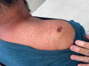 close up of skin abrasion on the top right of a man's shoulder