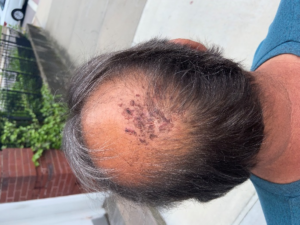 close up of head and scalp abrasions on exterior of male head