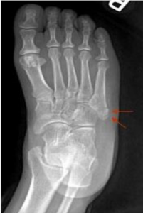 X-ray of a non-displaced fracture at the tip of the base of the middle of a foot.
