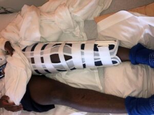 person shown waist down lying in hospital bed with left leg from ankle to thigh wrapped in a medical splint