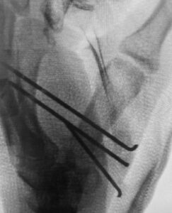 x-ray image of bone fracture in leg
