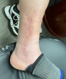 ankle fracture and ankle scar and healing