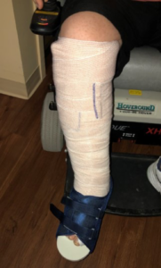 Ankle fracture and cast and tri-mal ankle 